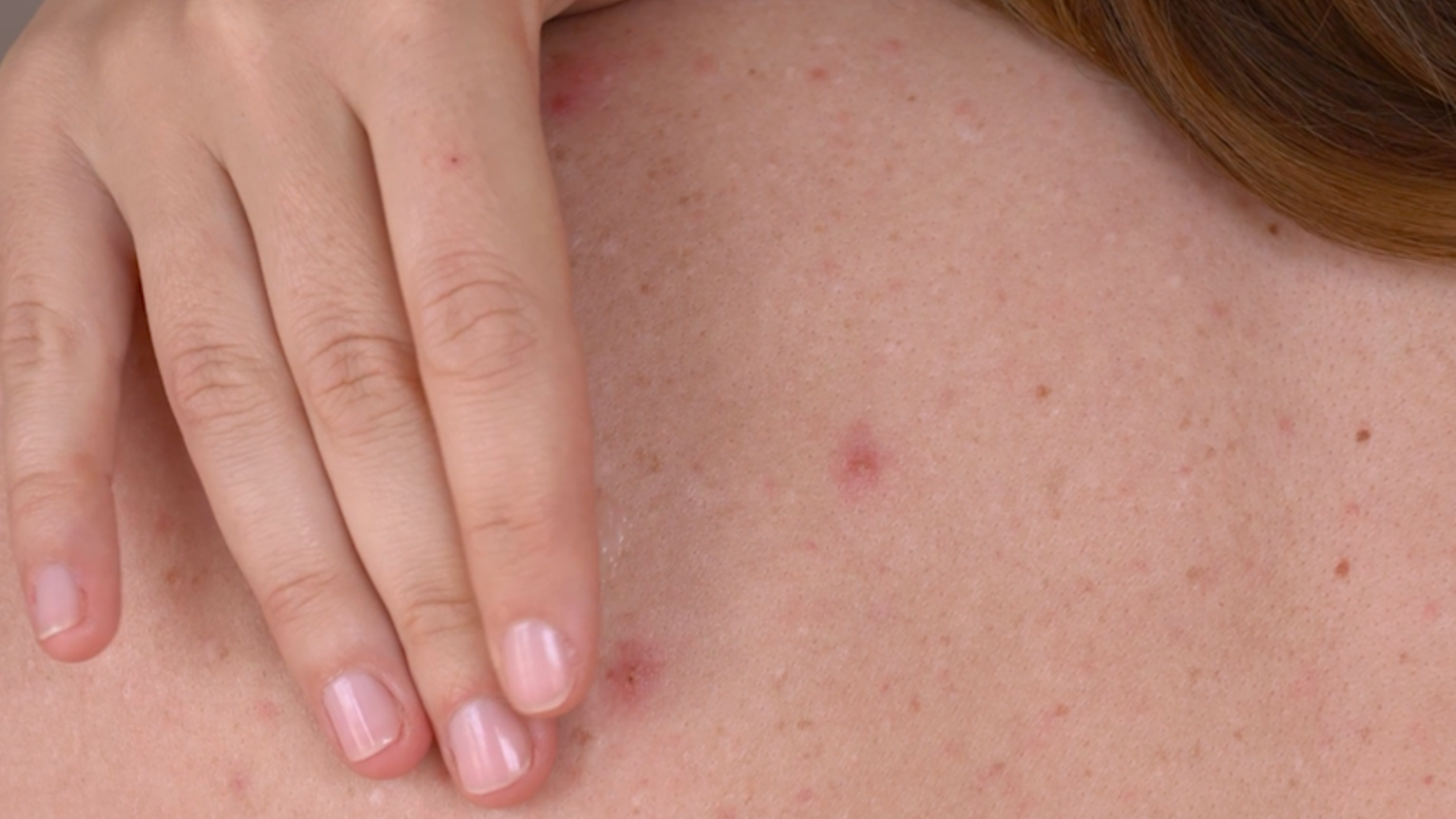 Ohio Department of Health declares state’s third 2026 measles outbreak