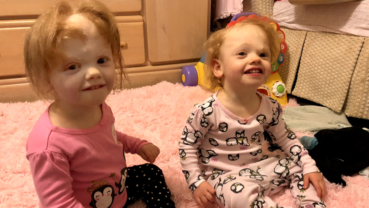 Conjoined twin sisters from NC doing well one year after separation