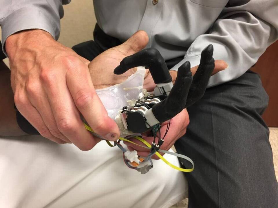 His ‘first in the world’ artificial hand now lets him move individual fingers