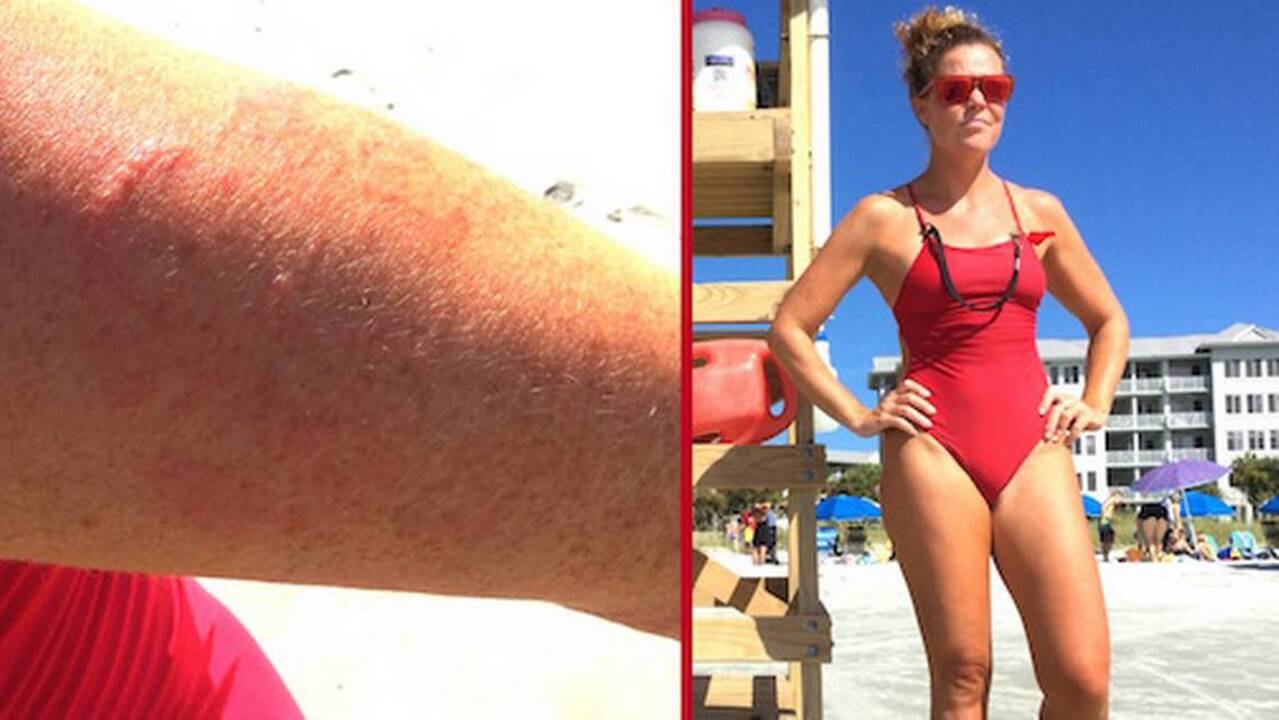 Hilton Head lifeguard: ‘On fire’ after multiple jellyfish stings