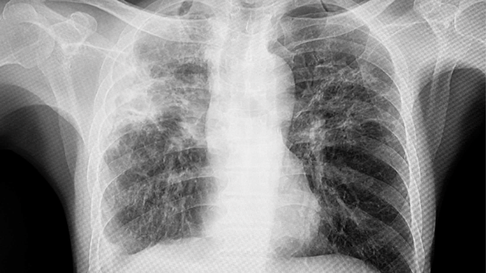 Tuberculosis cases hit a 12-year high in California. What to know
