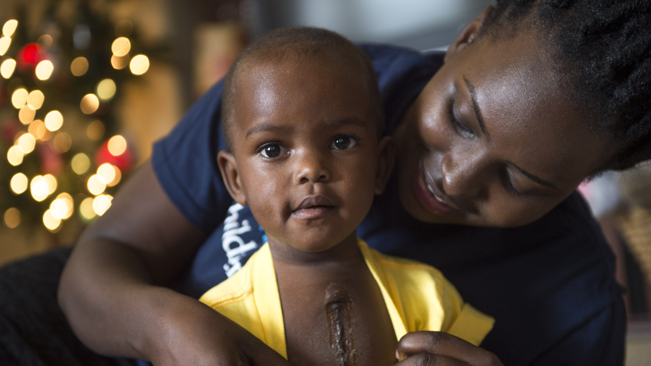Meet Davina, the Ugandan toddler who came to Sacramento for life-changing surgery