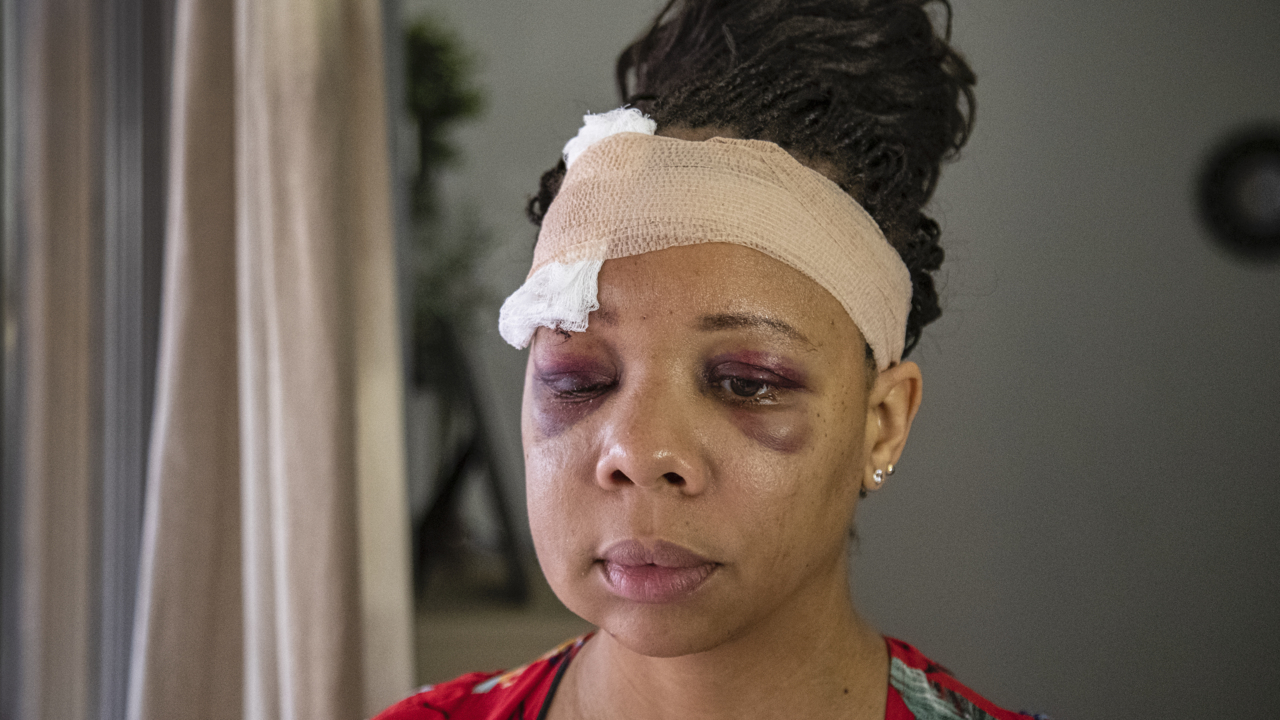 ‘Accusatory and ridiculous’: Woman shot with rubber bullet says police interrogated her