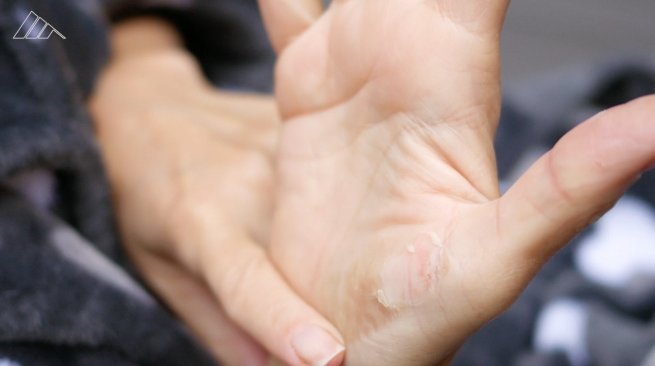 The types of burns and how to treat them