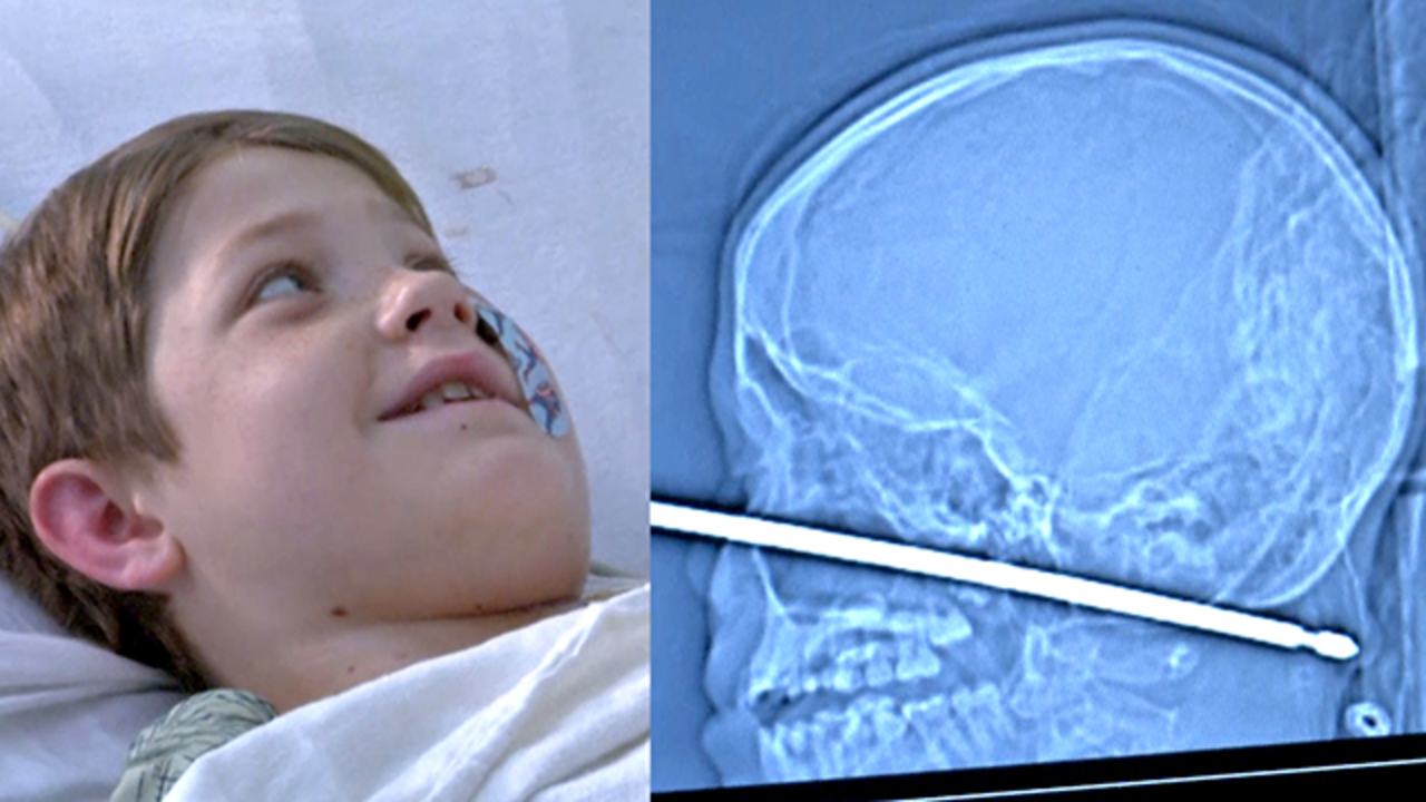 Ten-year-old boy survives fall on meat skewer that entered this skull