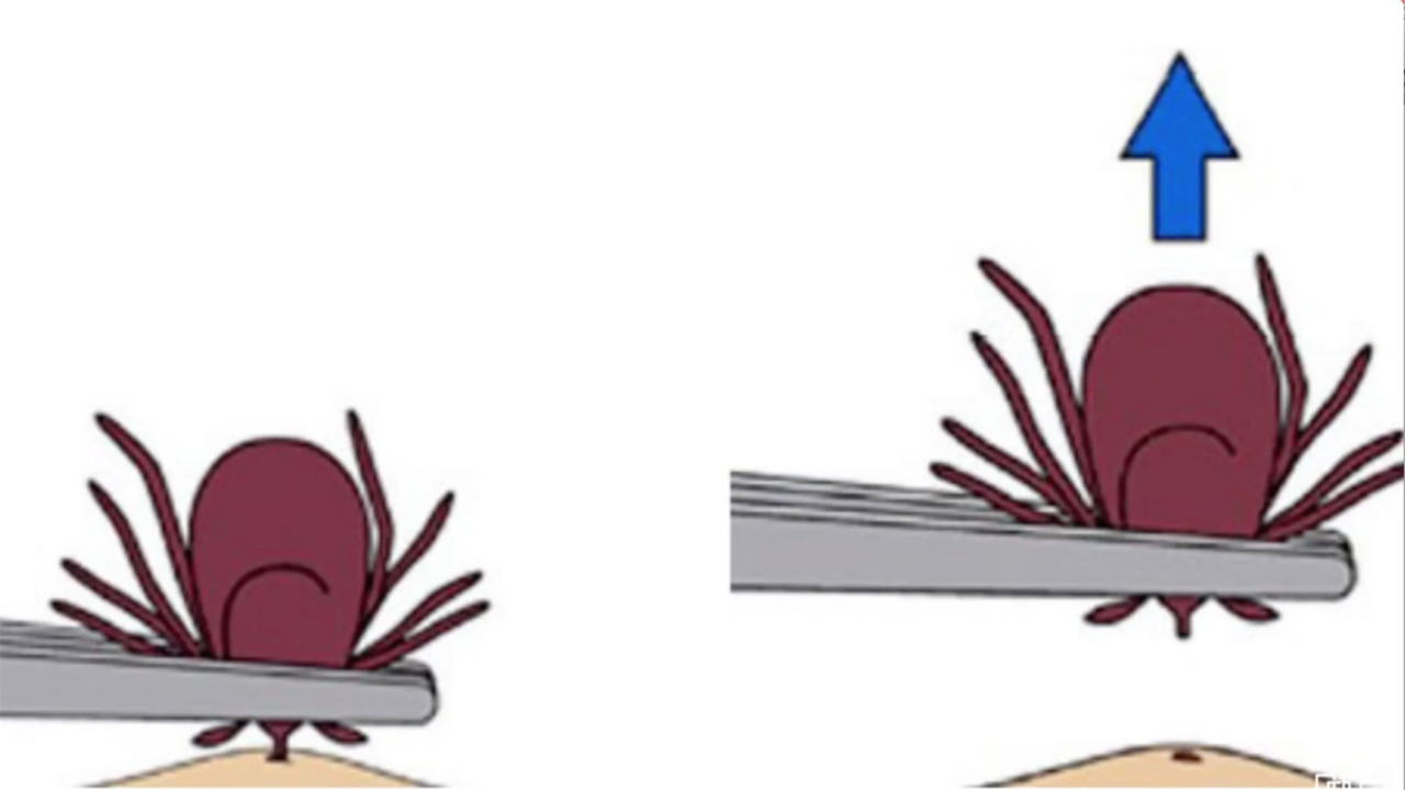 Mayo Clinic Minute - How to safely remove a tick