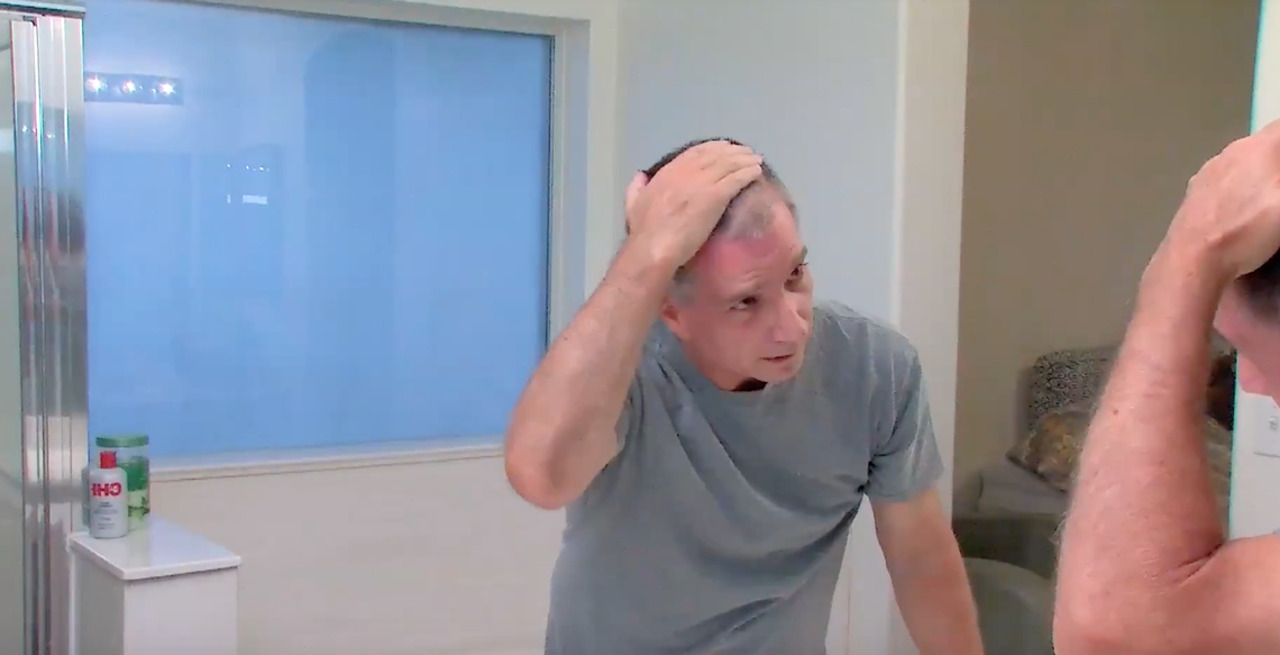 Treating male hair loss