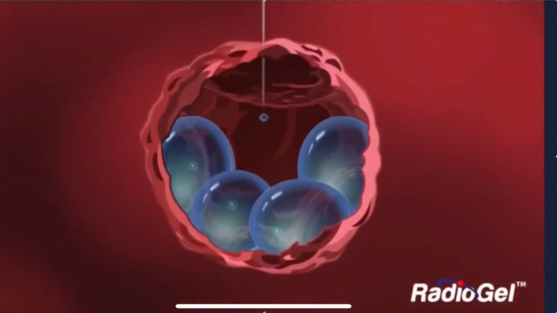 See how a new cancer therapy developed in Tri-Cities WA works