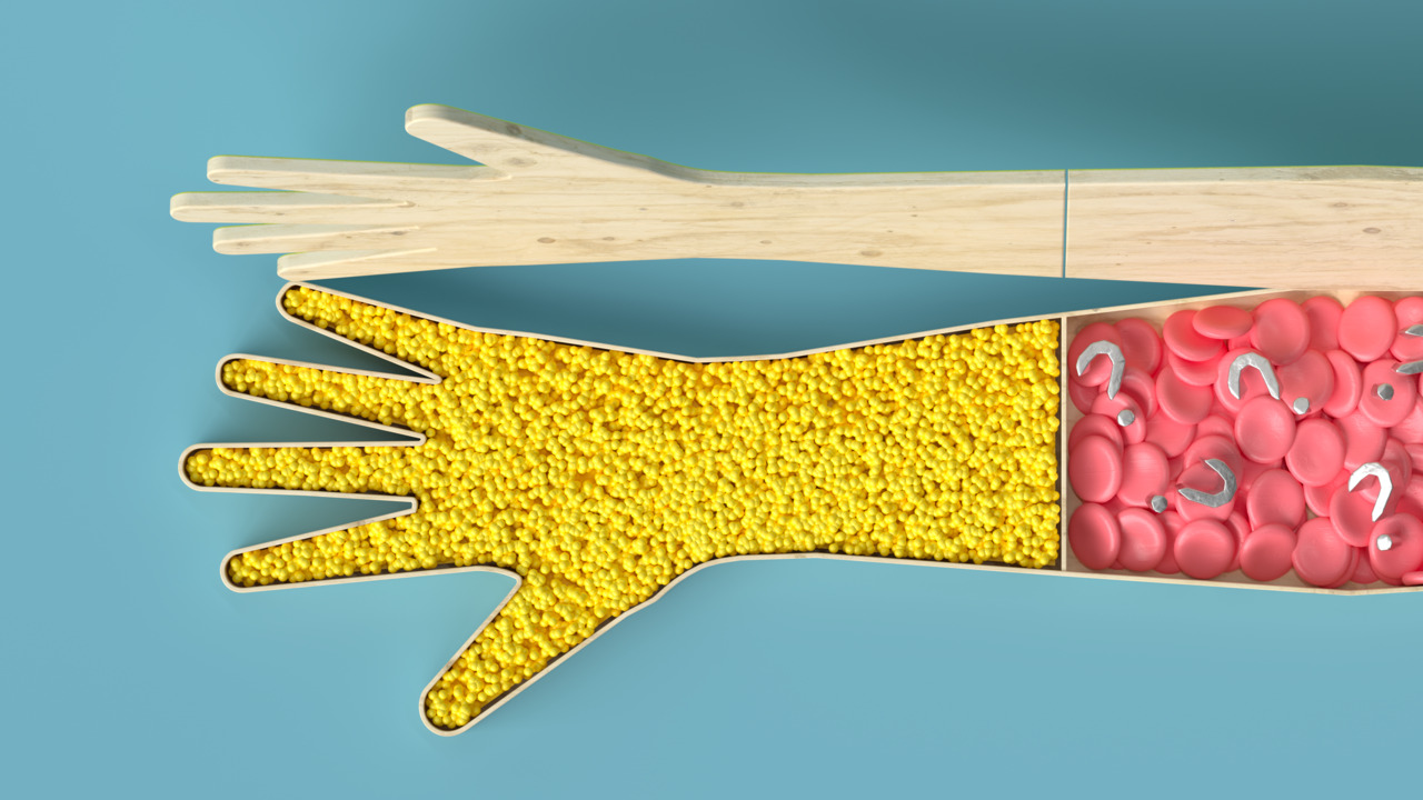 Plasma Files: How a device shelved for health reasons in France remained in use in U.S.