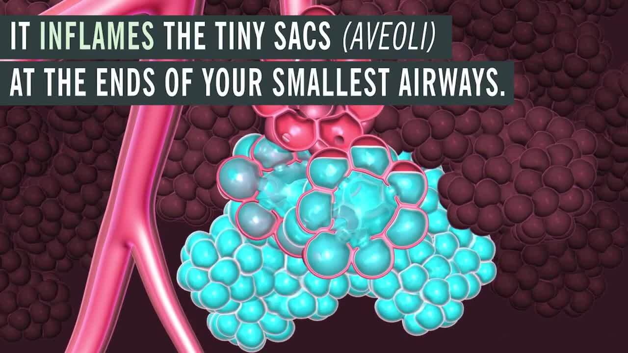 Bronchitis vs. Pneumonia: How are they Different?