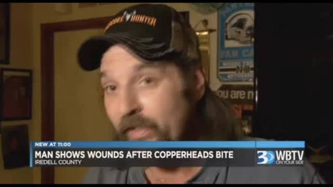 NC man shows his copperhead bites