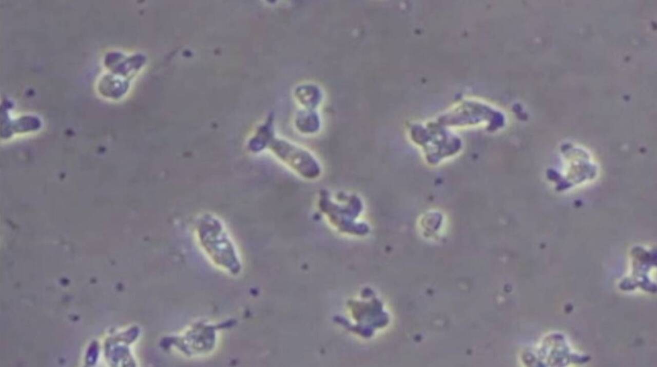New case of brain-eating amoeba reported in South Carolina