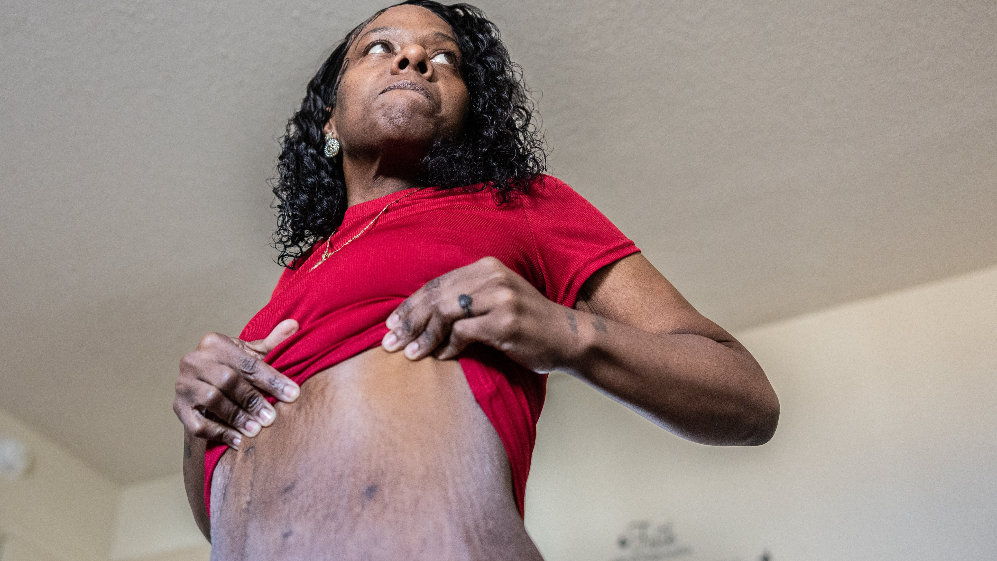 Tawanna Chambers talks about how her life changed after a surgery by Dr. Heider