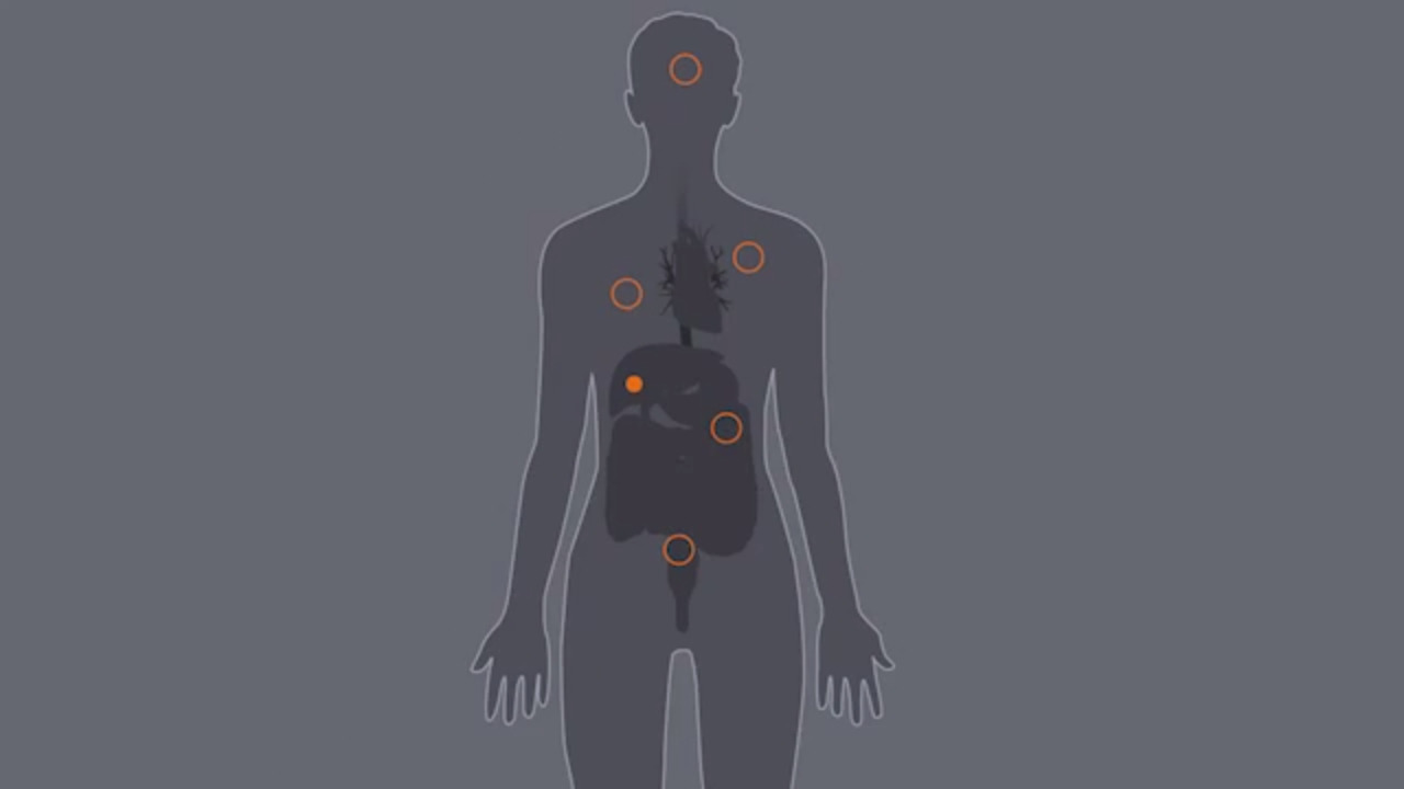 Testing matters. The difference between colon cancer screening, prevention | Opinion